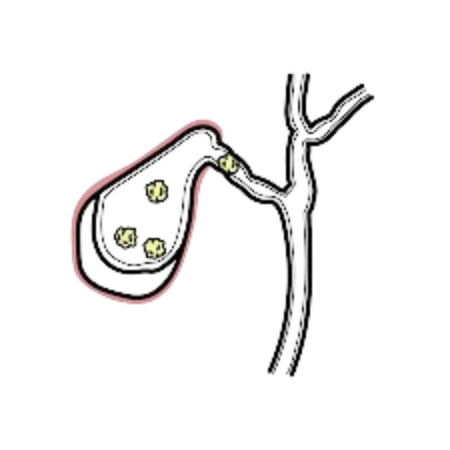 Cholecystitis